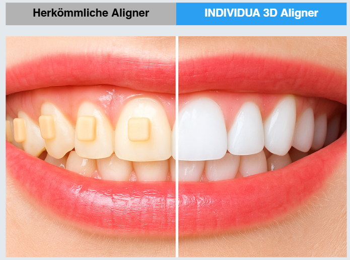 Smiling patient wearing clear aligner