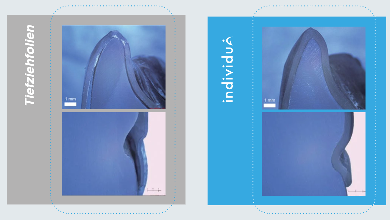 Transparent aligner under soft light
